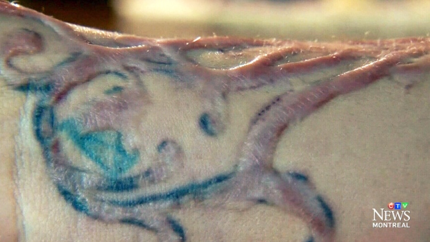 CTV Montreal: Tattoo removal leaves ugly scars | CTV ...